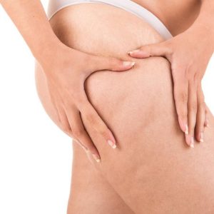 Ridurre gli inestetismi della cellulite