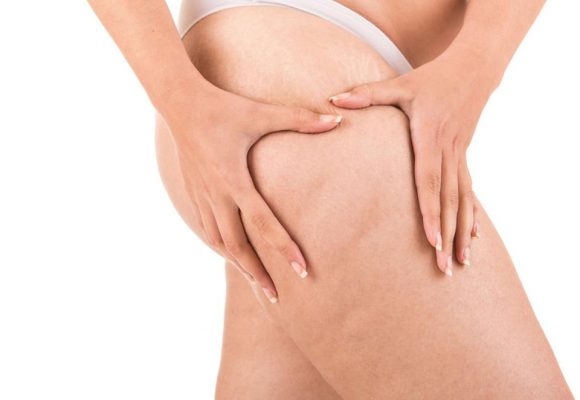 Ridurre gli inestetismi della cellulite